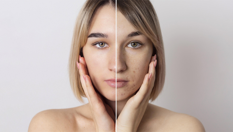 Managing Acne and Acne Scars