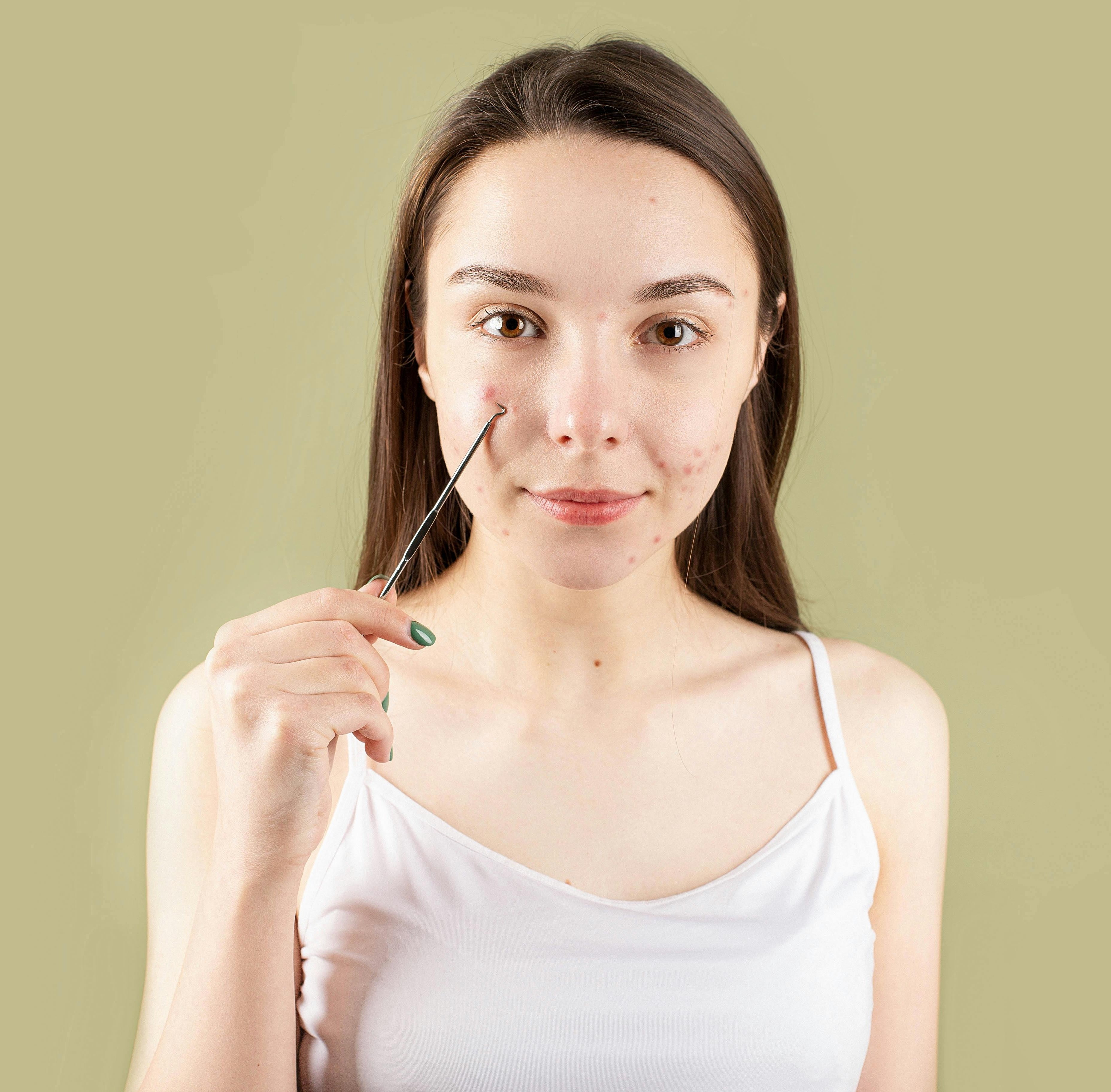 Acne Treatment in Chennai